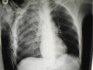 Pulmonary contusion.jpg